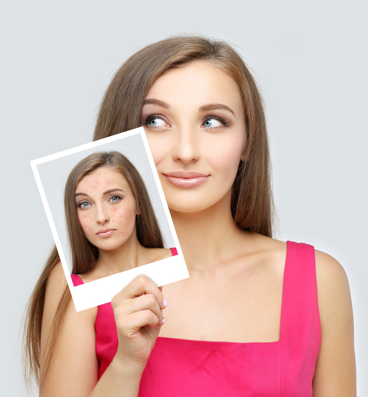 Rosacea.Girl with problem and clear skin.