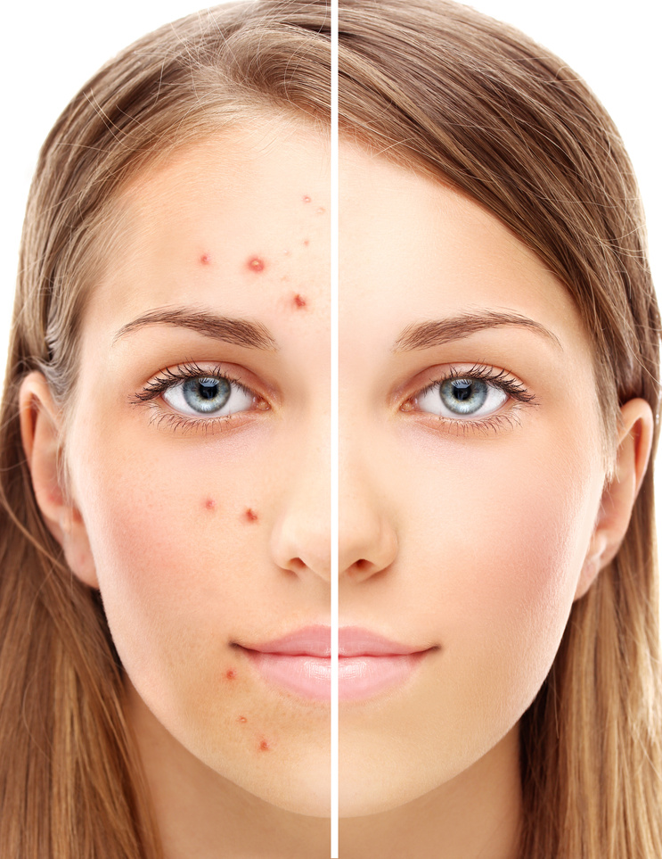 Girl with problem and clear skin.