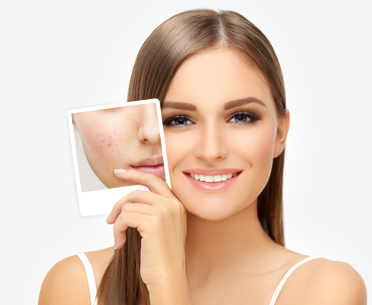 Girl  with problem and clear skin.